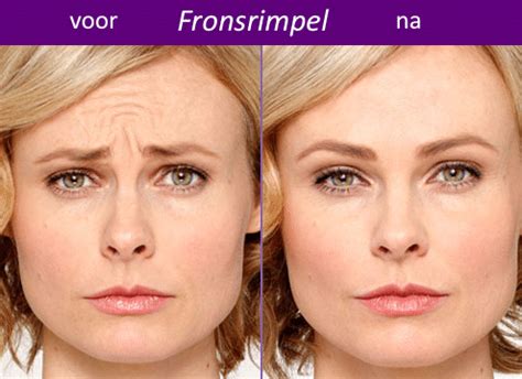 botox behandeling eindhoven.